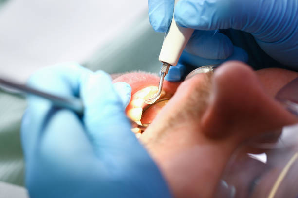 Best Emergency Dental Surgery in Belleair, FL